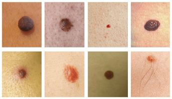 The most common skin spots is nevus and papilloma (warts)