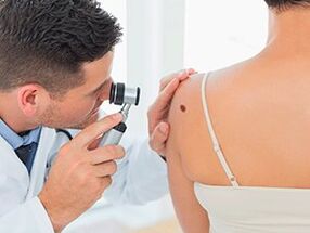 doctor examines the papilloma, recommends removing it with drugs