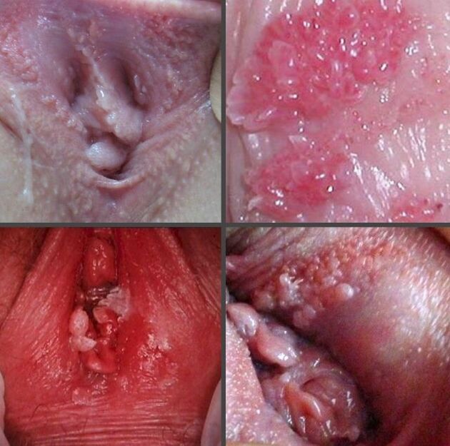Papilloma close-up vagina