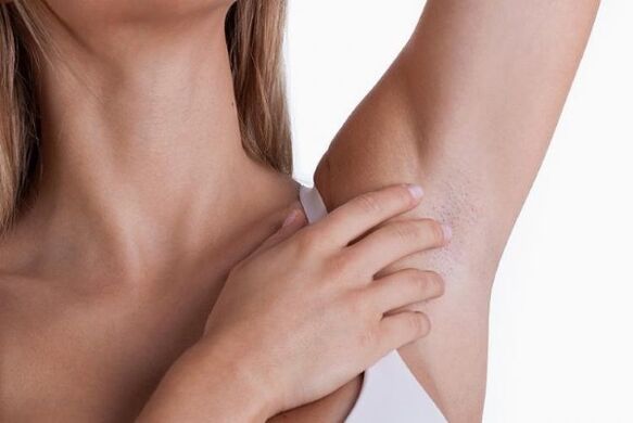 papillomas under the armpits in a woman