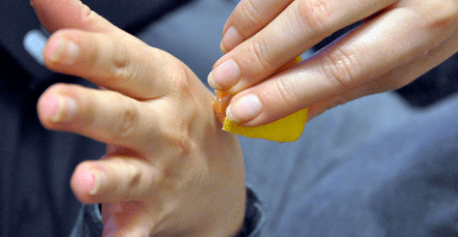 wart removal by hand