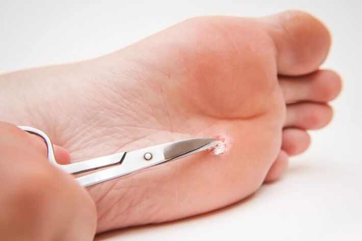 cutting out the wart on the leg