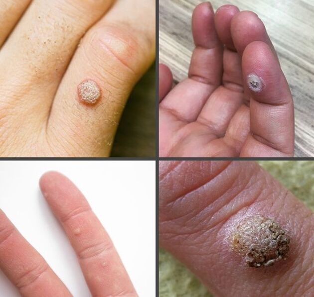 The most common types of warts on fingers