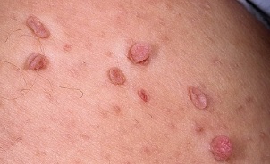 causes of papillomas appear on the body