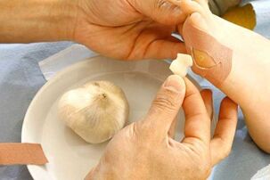 Papilloma treatment with garlic compress